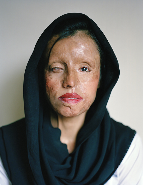 Women Survivors Of Acid Attacks She Is Beautiful